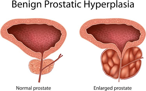 How can we remove the entire portion of the prostate that can block urine flow?